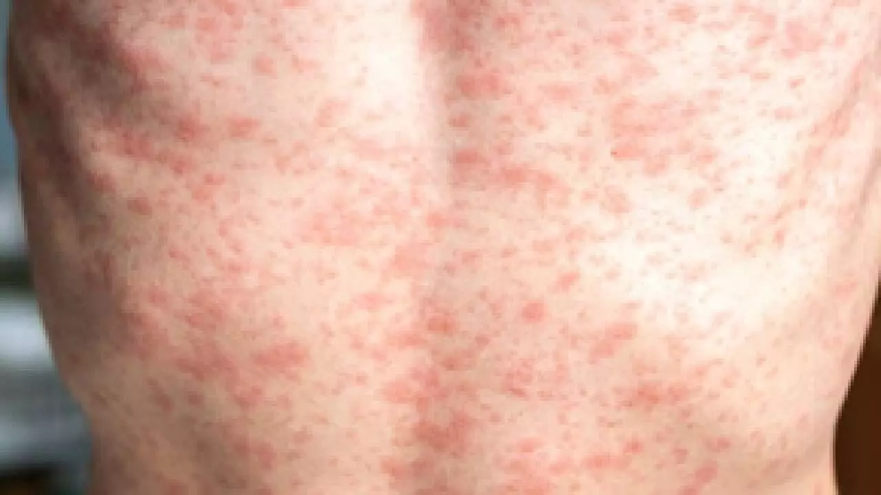 Over 900 measles cases reported in US so far in 2025: CDC Over 900 measles cases reported in US so far in 2025: CDC