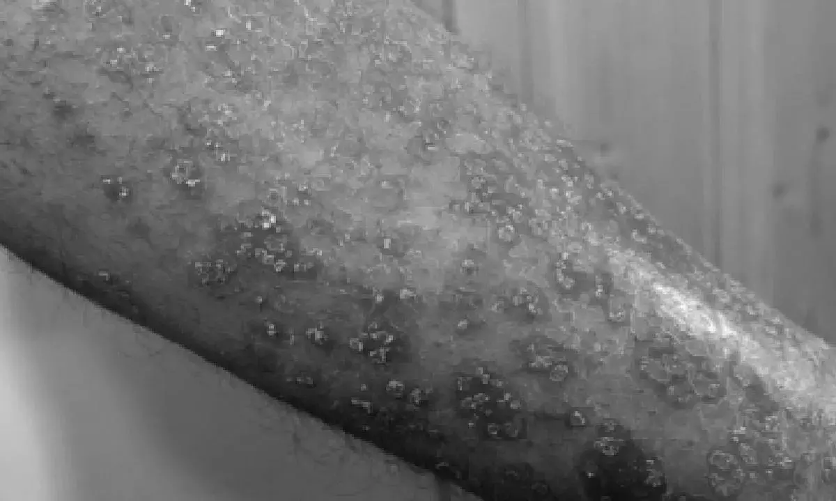 Study shows why psoriasis patients may be at risk of obesity, fatty liver disease