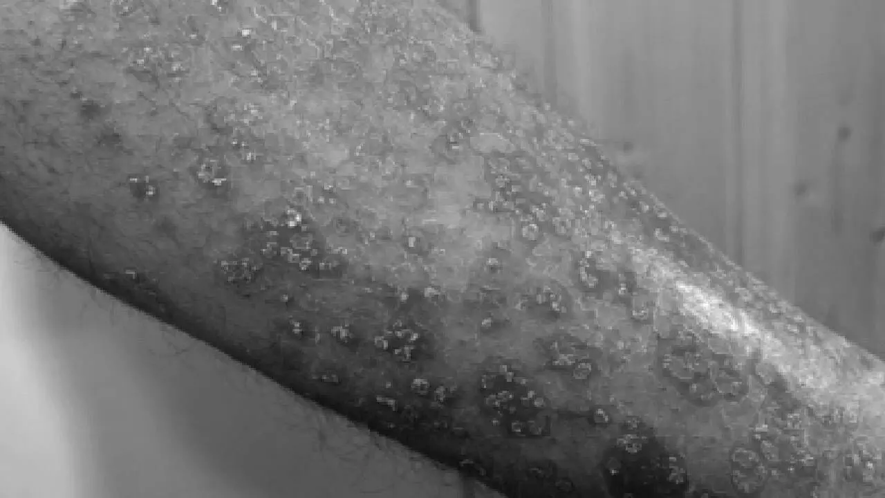Study shows why psoriasis patients may be at risk of obesity, fatty liver disease Study shows why psoriasis patients may be at risk of obesity, fatty liver disease