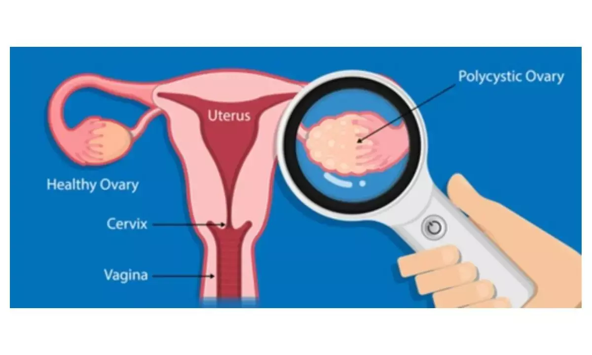 Women with PCOS likely to cause attention, cognitive issues: Study