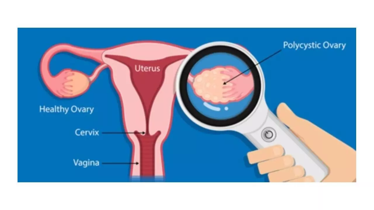 Women with PCOS likely to cause attention, cognitive issues: Study Women with PCOS likely to cause attention, cognitive issues: Study