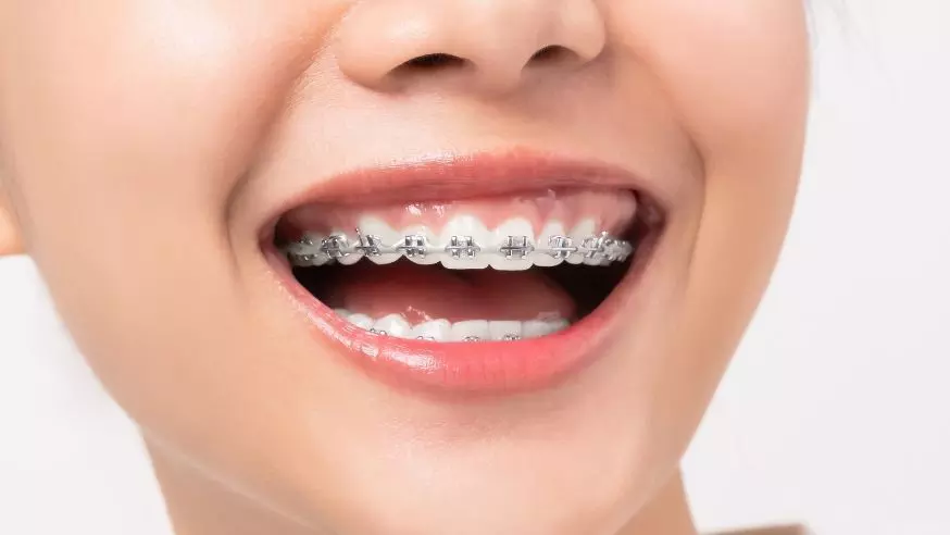 Brighter Smiles Ahead: When Is the Right Time for Braces for Kids? Brighter Smiles Ahead: When Is the Right Time for Braces for Kids?