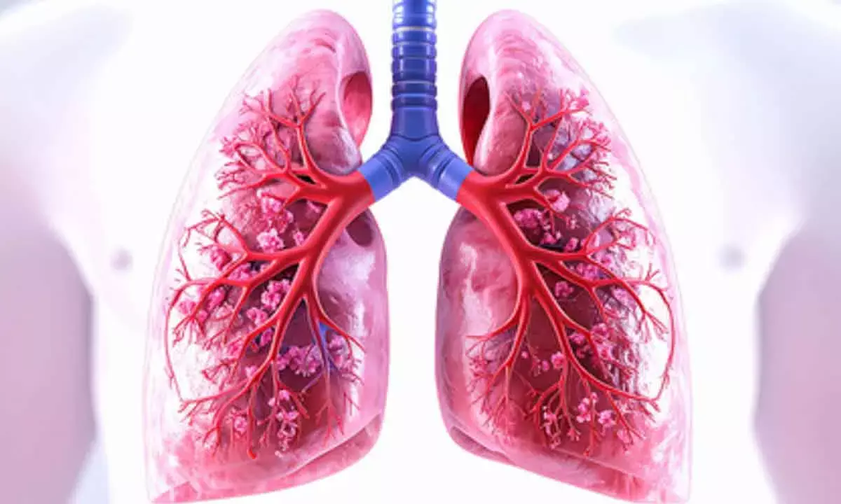 Antibody drug shows promise against lung cancer in human trial