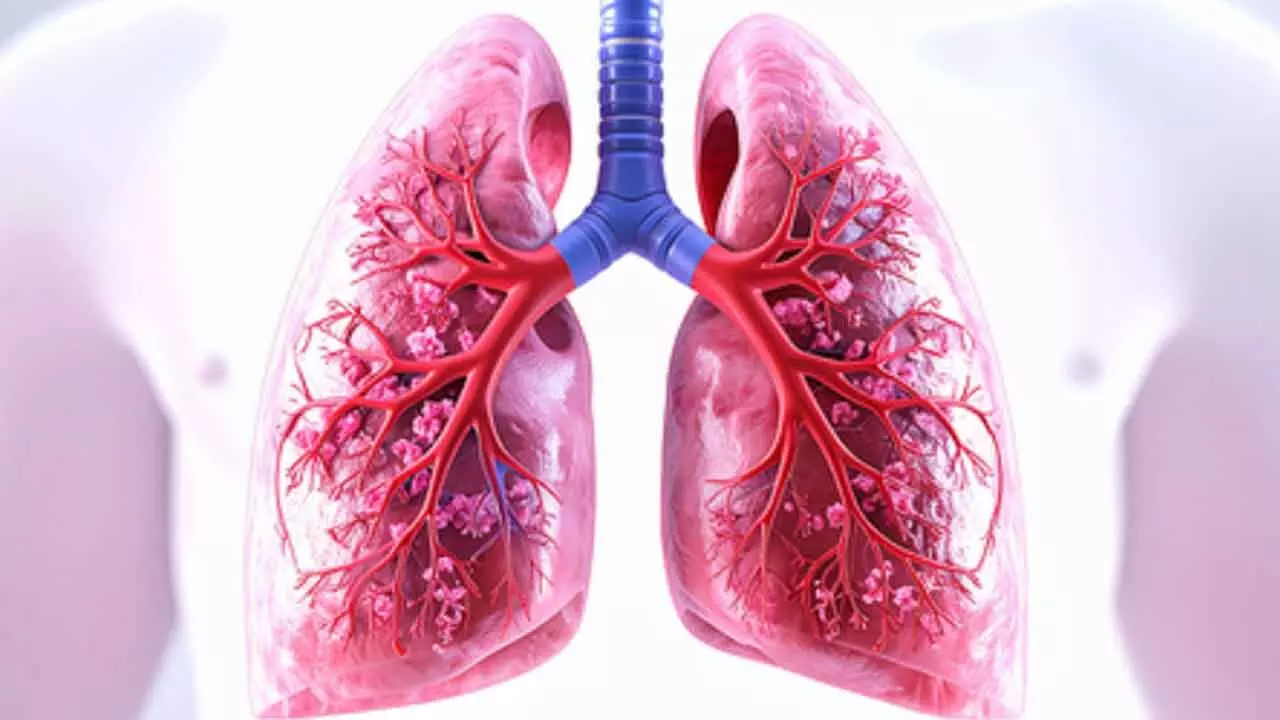 Antibody drug shows promise against lung cancer in human trial Antibody drug shows promise against lung cancer in human trial