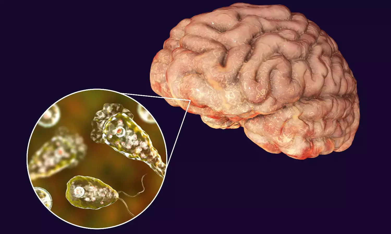 Kerala on Alert: 19 Dead from Brain-Eating Amoeba | Symptoms, Causes & Latest Updates