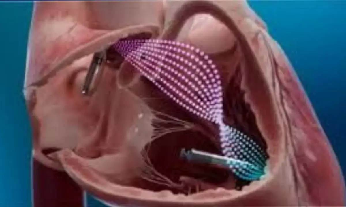 dual-chamber leadless pacemaker launched