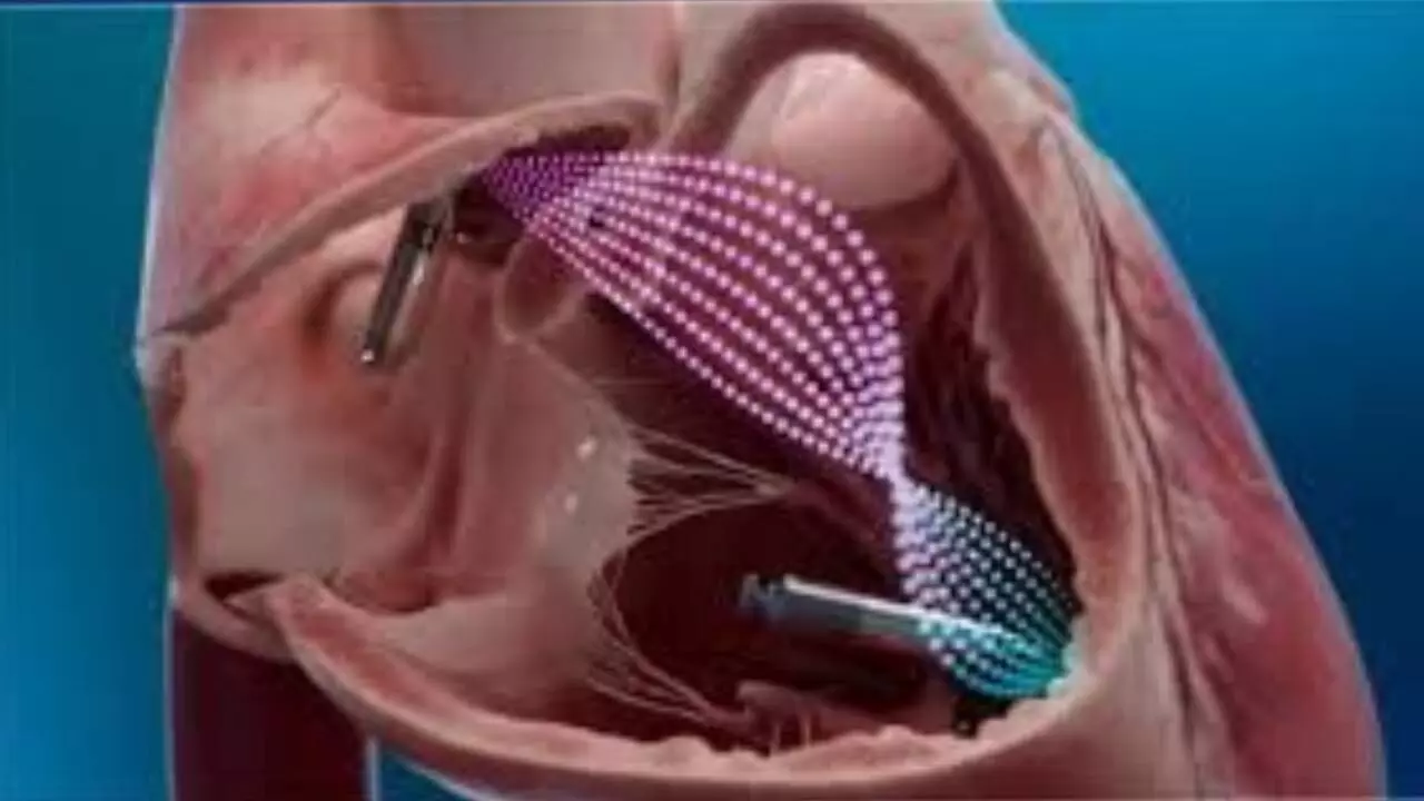 dual-chamber leadless pacemaker launched