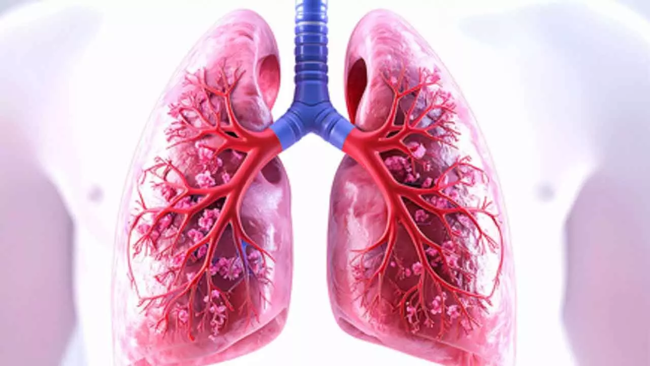 Chest X-rays may not detect asymptomatic TB among household contacts: Lancet report