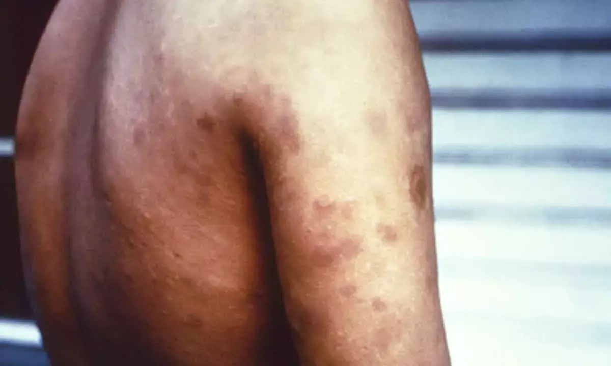Leprosy now a notifiable disease in Maharashtra