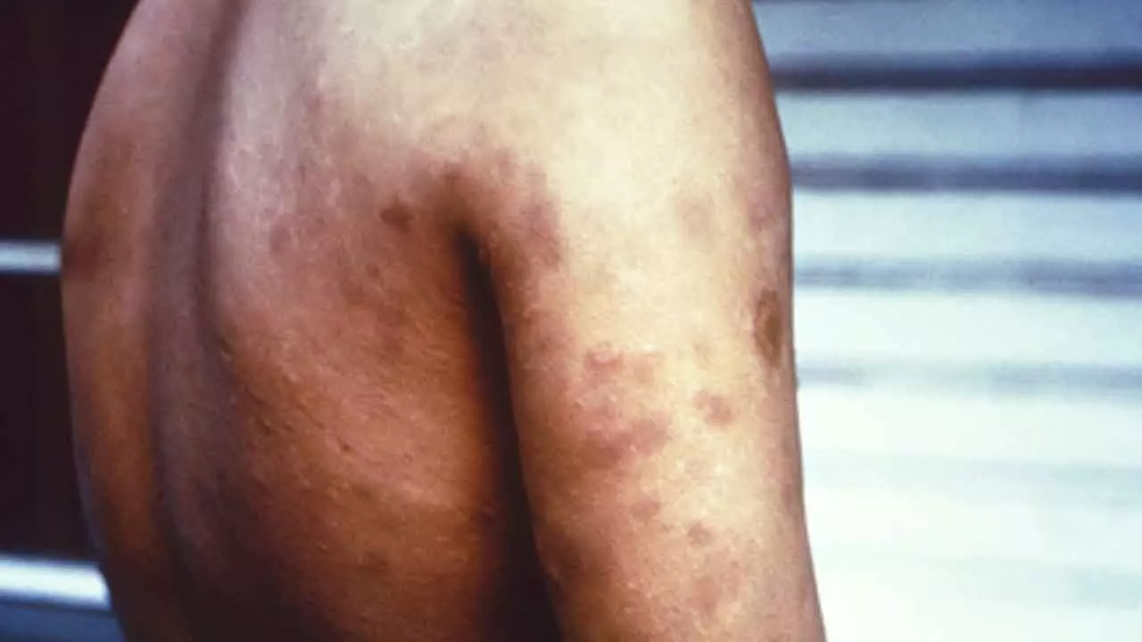 Leprosy now a notifiable disease in Maharashtra