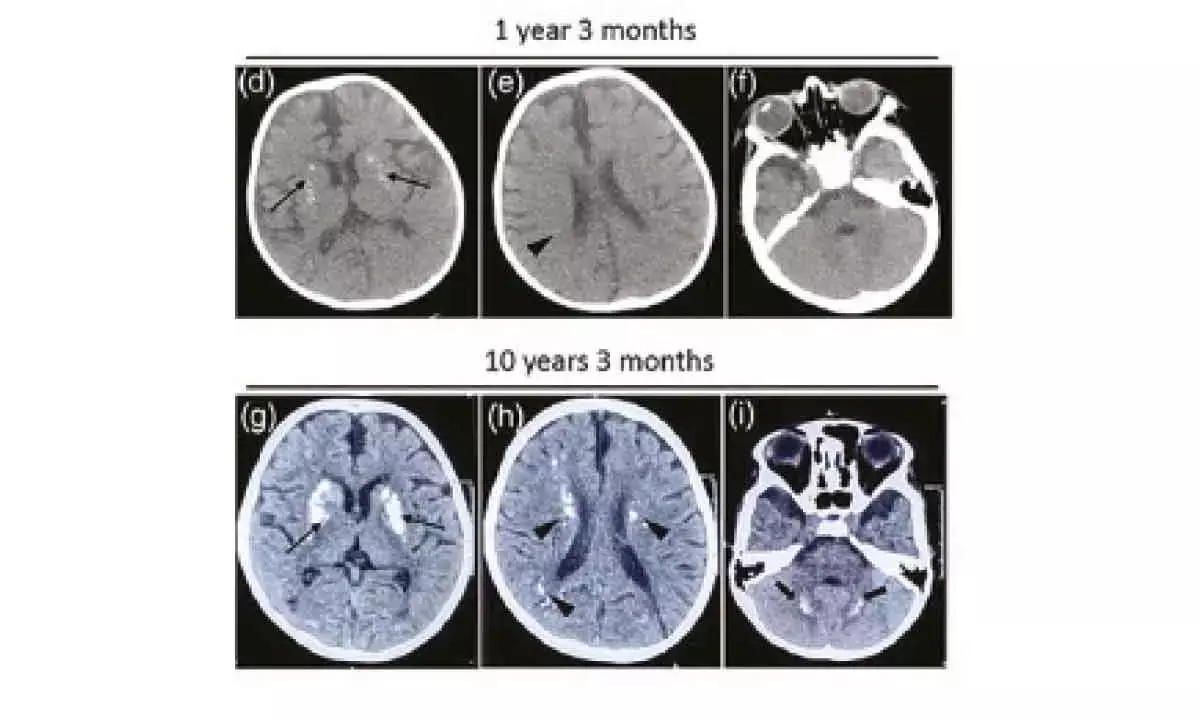 Rare gene mutation linked to recurrent neuro decline in kids found