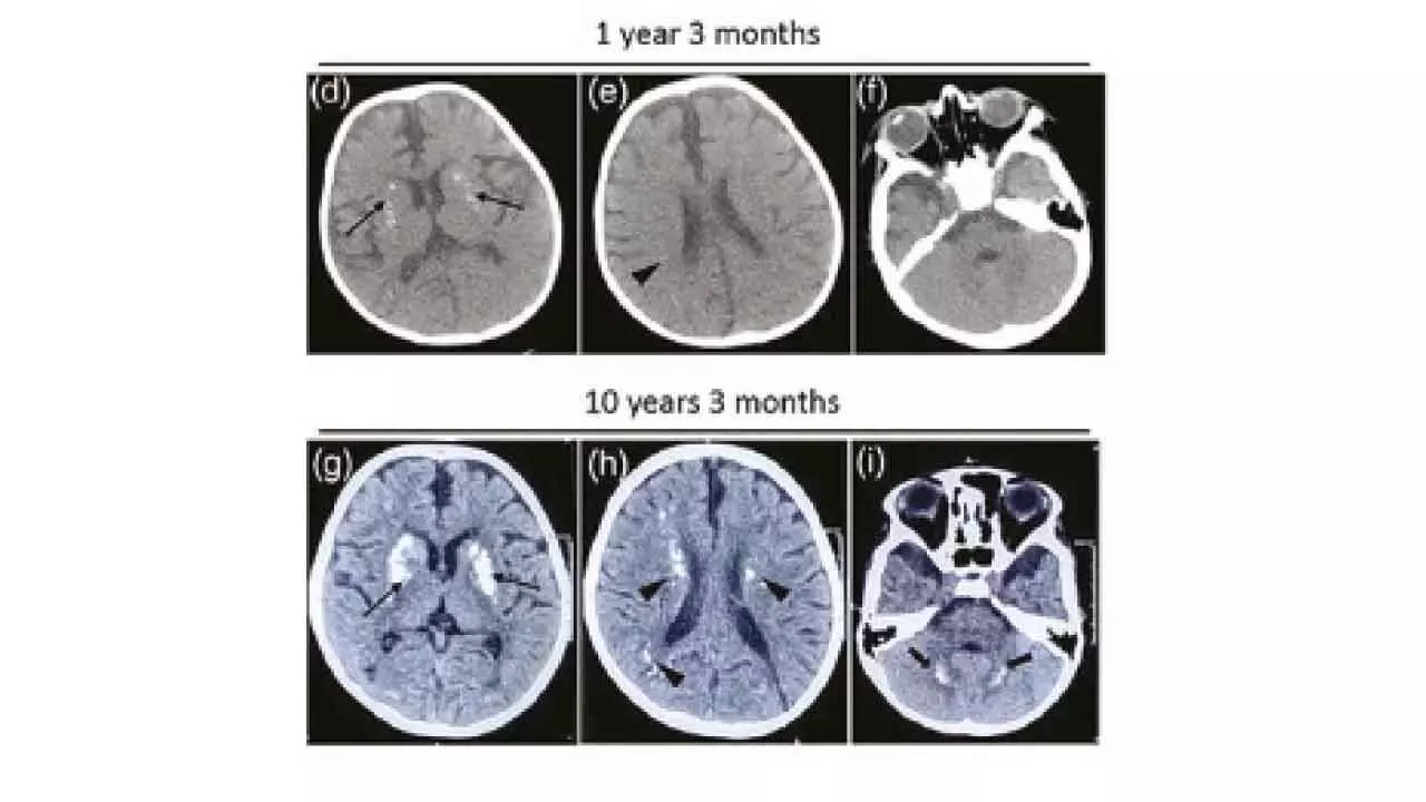 Rare gene mutation linked to recurrent neuro decline in kids found