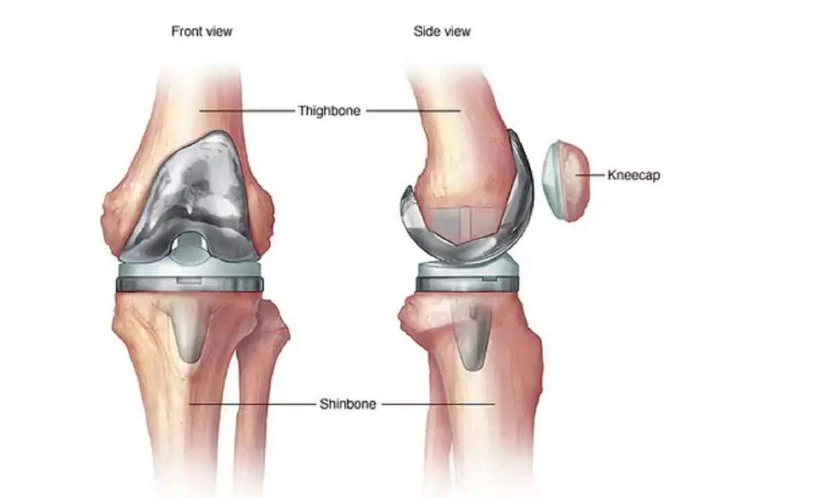 We need more skilled surgeons for revision knee, hip replacement surgeries: Experts