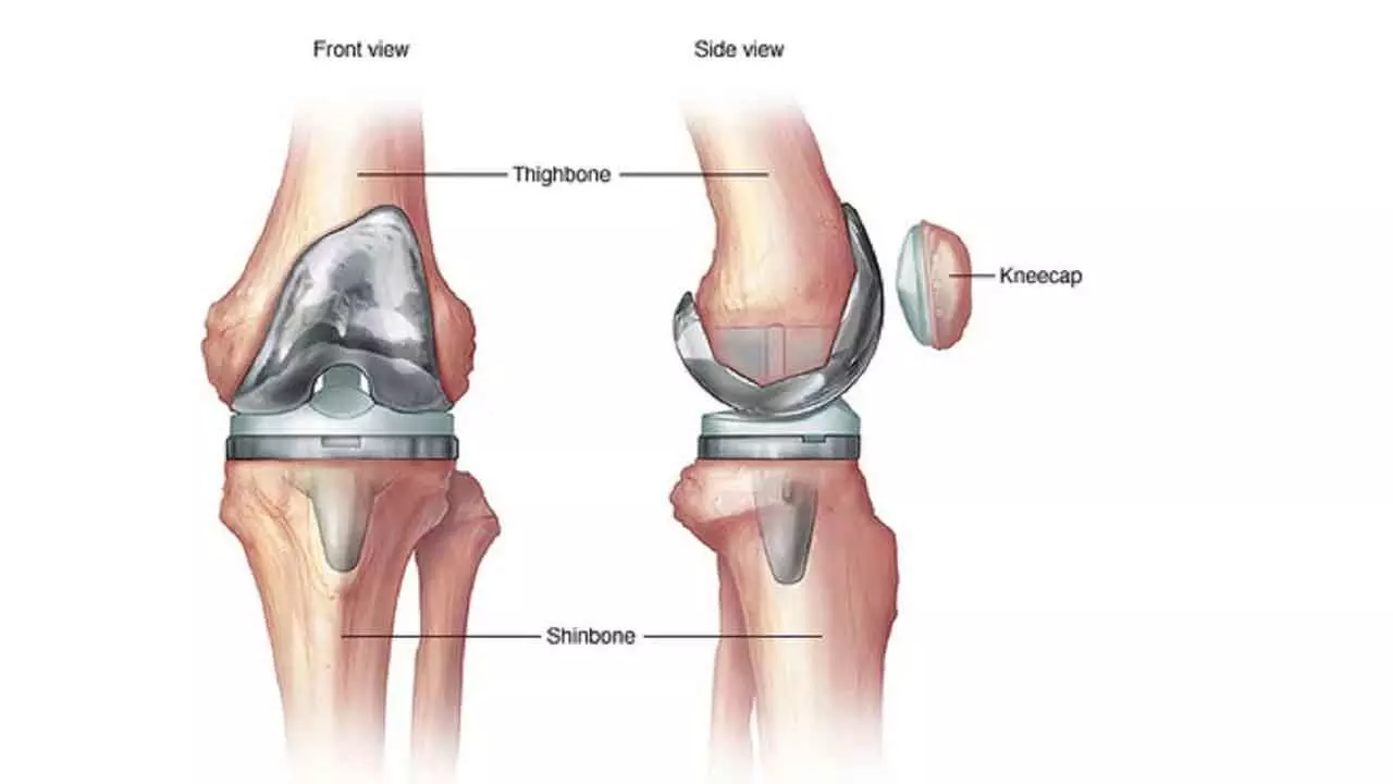 We need more skilled surgeons for revision knee, hip replacement surgeries: Experts We need more skilled surgeons for revision knee, hip replacement surgeries: Experts