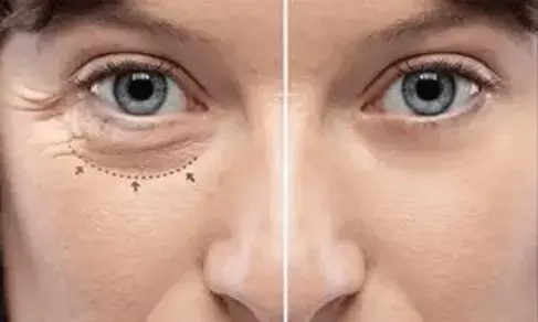 Dry Eyes in Winter: Causes and Symptoms and Easy Home Remedies