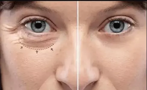 Dry Eyes in Winter: Causes and Symptoms and Easy Home Remedies Dry Eyes in Winter: Causes and Symptoms and Easy Home Remedies