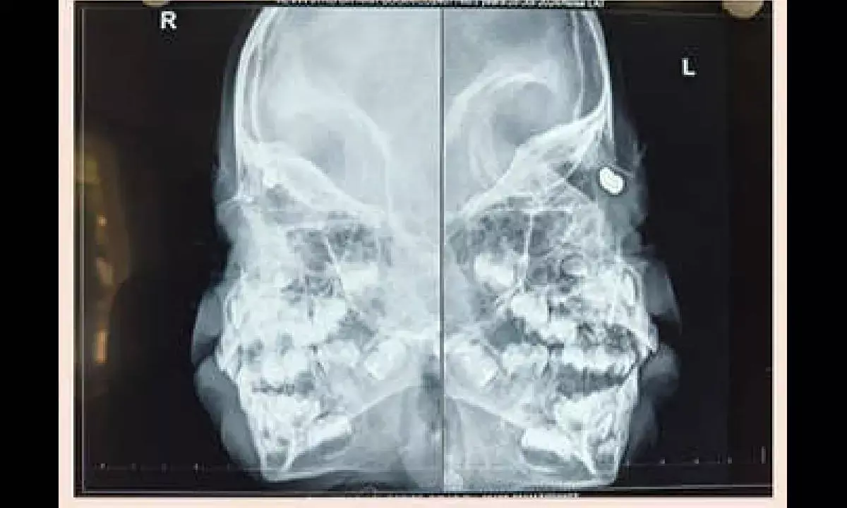 Sankara Hospital performs rare surgery