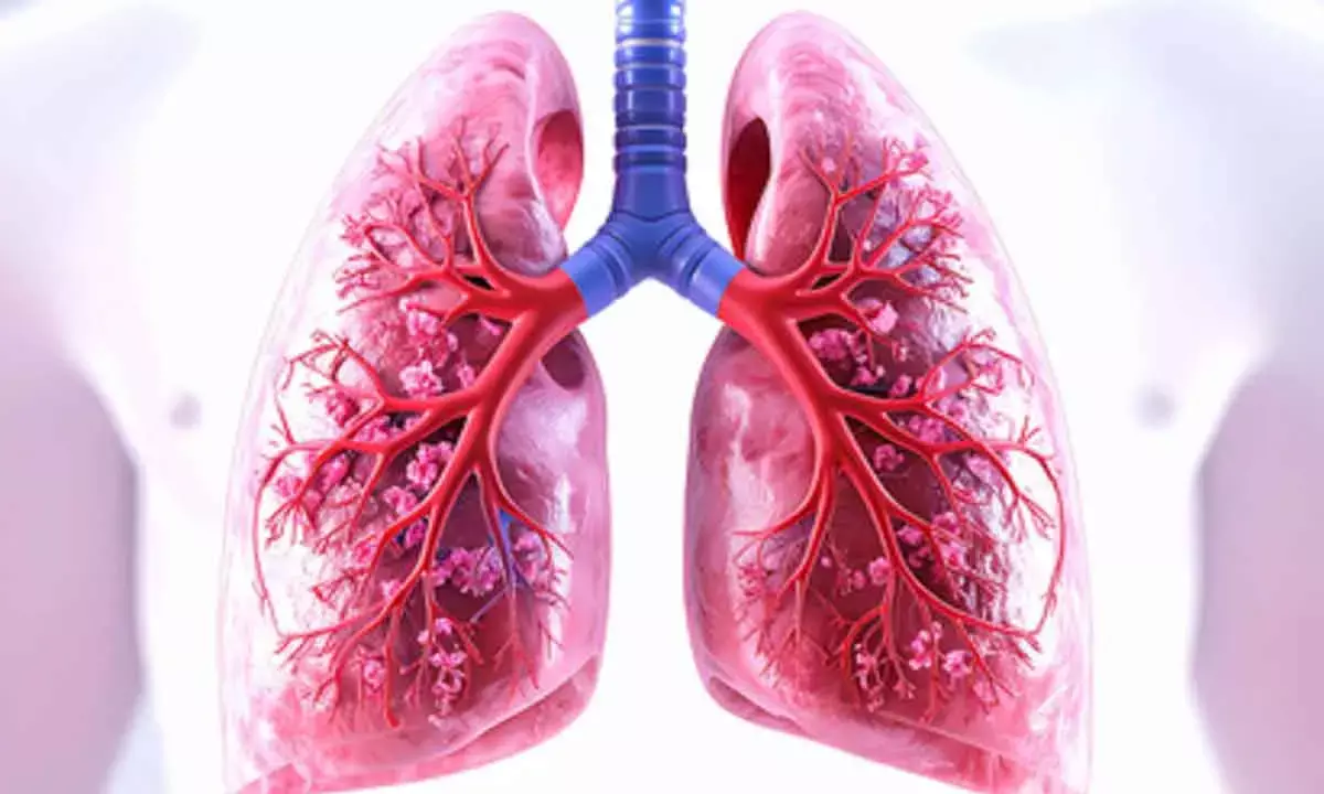 New blood test can detect, monitor lung cancer in real time