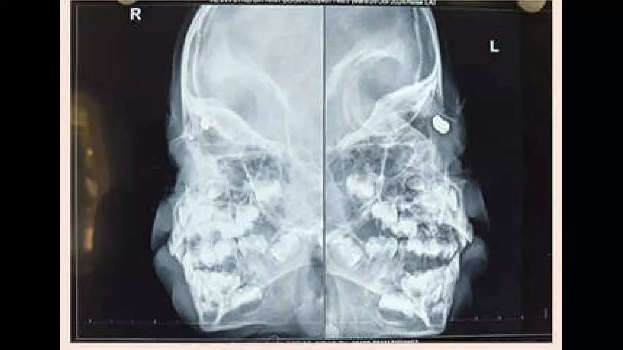 Sankara Hospital performs rare surgery Sankara Hospital performs rare surgery