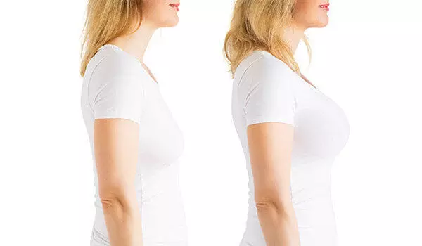 The Rise of Natural Confidence, Breast Lift in Dubai The Rise of Natural Confidence, Breast Lift in Dubai
