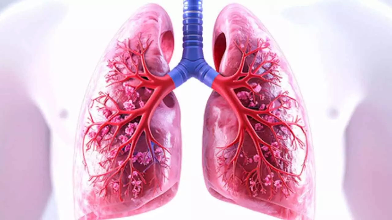 New blood test can detect, monitor lung cancer in real time New blood test can detect, monitor lung cancer in real time