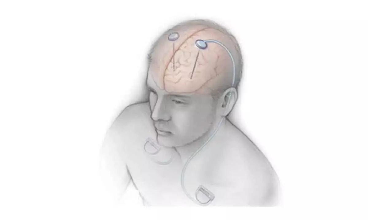 AIIMS conducts India’s 1st DBS workshop for Parkinson’s, movement disorders