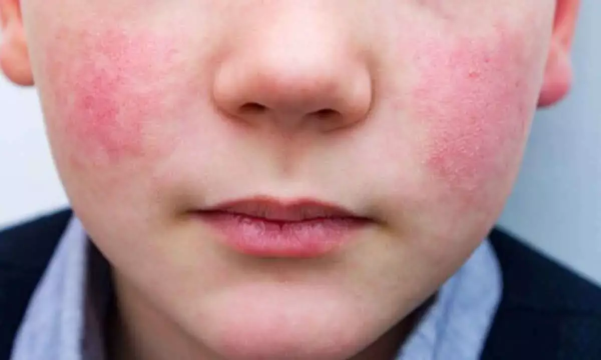 Common parvovirus B19 can cause serious encephalitis: AIIMS Bhopal